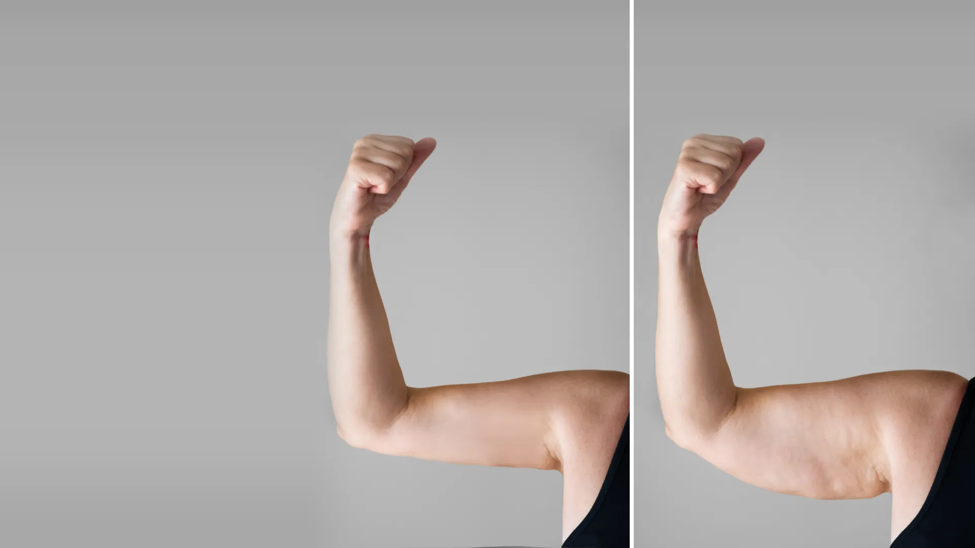 Arm Fat Removal