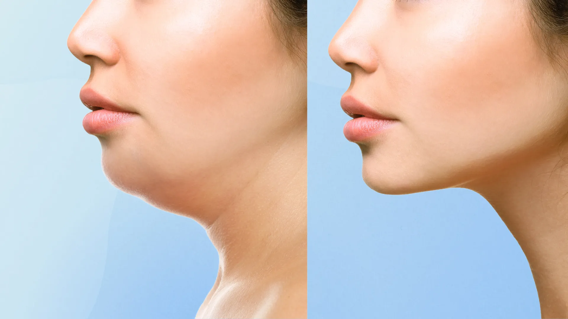 Chin Fat Removal